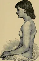 An illustration from Atlas and epitome of traumatic fractures and dislocations / by H. Helferich ; auth. tr. from the German, ed. by Joseph C. Bloodgood. (1902)