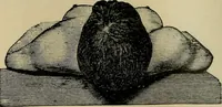An illustration from Atlas and epitome of traumatic fractures and dislocations / by H. Helferich ; auth. tr. from the German, ed. by Joseph C. Bloodgood. (1902)