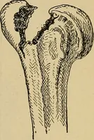 An illustration from Atlas and epitome of traumatic fractures and dislocations / by H. Helferich ; auth. tr. from the German, ed. by Joseph C. Bloodgood. (1902)