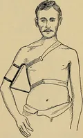 An illustration from Atlas and epitome of traumatic fractures and dislocations / by H. Helferich ; auth. tr. from the German, ed. by Joseph C. Bloodgood. (1902)