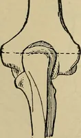 Picture 41 of 91 from Atlas and epitome of traumatic fractures and dislocations / by H. Helferich ; auth. tr. from the German, ed. by Joseph C. Bloodgood. (1902), leaf 252