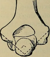An illustration from Atlas and epitome of traumatic fractures and dislocations / by H. Helferich ; auth. tr. from the German, ed. by Joseph C. Bloodgood. (1902)