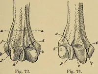 An illustration from Atlas and epitome of traumatic fractures and dislocations / by H. Helferich ; auth. tr. from the German, ed. by Joseph C. Bloodgood. (1902)