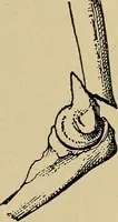 An illustration from Atlas and epitome of traumatic fractures and dislocations / by H. Helferich ; auth. tr. from the German, ed. by Joseph C. Bloodgood. (1902)