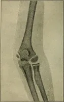 Picture 47 of 91 from Atlas and epitome of traumatic fractures and dislocations / by H. Helferich ; auth. tr. from the German, ed. by Joseph C. Bloodgood. (1902), leaf 262