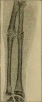 An illustration from Atlas and epitome of traumatic fractures and dislocations / by H. Helferich ; auth. tr. from the German, ed. by Joseph C. Bloodgood. (1902)