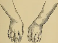 An illustration from Atlas and epitome of traumatic fractures and dislocations / by H. Helferich ; auth. tr. from the German, ed. by Joseph C. Bloodgood. (1902)