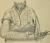 Picture 49 of 91 from Atlas and epitome of traumatic fractures and dislocations / by H. Helferich ; auth. tr. from the German, ed. by Joseph C. Bloodgood. (1902), leaf 294