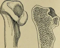 An illustration from Atlas and epitome of traumatic fractures and dislocations / by H. Helferich ; auth. tr. from the German, ed. by Joseph C. Bloodgood. (1902)