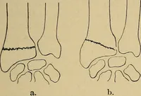 An illustration from Atlas and epitome of traumatic fractures and dislocations / by H. Helferich ; auth. tr. from the German, ed. by Joseph C. Bloodgood. (1902)