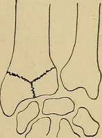 An illustration from Atlas and epitome of traumatic fractures and dislocations / by H. Helferich ; auth. tr. from the German, ed. by Joseph C. Bloodgood. (1902)
