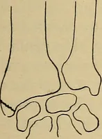 An illustration from Atlas and epitome of traumatic fractures and dislocations / by H. Helferich ; auth. tr. from the German, ed. by Joseph C. Bloodgood. (1902)