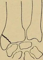 An illustration from Atlas and epitome of traumatic fractures and dislocations / by H. Helferich ; auth. tr. from the German, ed. by Joseph C. Bloodgood. (1902)