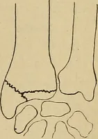 An illustration from Atlas and epitome of traumatic fractures and dislocations / by H. Helferich ; auth. tr. from the German, ed. by Joseph C. Bloodgood. (1902)