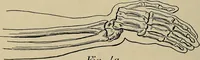 An illustration from Atlas and epitome of traumatic fractures and dislocations / by H. Helferich ; auth. tr. from the German, ed. by Joseph C. Bloodgood. (1902)