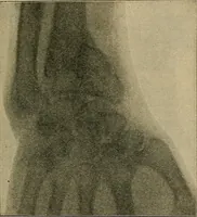 Picture 59 of 91 from Atlas and epitome of traumatic fractures and dislocations / by H. Helferich ; auth. tr. from the German, ed. by Joseph C. Bloodgood. (1902), leaf 323