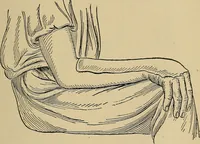 An illustration from Atlas and epitome of traumatic fractures and dislocations / by H. Helferich ; auth. tr. from the German, ed. by Joseph C. Bloodgood. (1902)