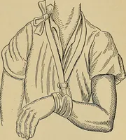 Picture 61 of 91 from Atlas and epitome of traumatic fractures and dislocations / by H. Helferich ; auth. tr. from the German, ed. by Joseph C. Bloodgood. (1902), leaf 327