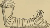An illustration from Atlas and epitome of traumatic fractures and dislocations / by H. Helferich ; auth. tr. from the German, ed. by Joseph C. Bloodgood. (1902)
