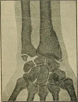 An illustration from Atlas and epitome of traumatic fractures and dislocations / by H. Helferich ; auth. tr. from the German, ed. by Joseph C. Bloodgood. (1902)