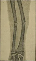 An illustration from Atlas and epitome of traumatic fractures and dislocations / by H. Helferich ; auth. tr. from the German, ed. by Joseph C. Bloodgood. (1902)
