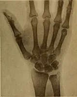 Picture 65 of 91 from Atlas and epitome of traumatic fractures and dislocations / by H. Helferich ; auth. tr. from the German, ed. by Joseph C. Bloodgood. (1902), leaf 331