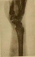 Picture 66 of 91 from Atlas and epitome of traumatic fractures and dislocations / by H. Helferich ; auth. tr. from the German, ed. by Joseph C. Bloodgood. (1902), leaf 335