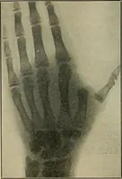 Picture 67 of 91 from Atlas and epitome of traumatic fractures and dislocations / by H. Helferich ; auth. tr. from the German, ed. by Joseph C. Bloodgood. (1902), leaf 338