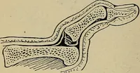 An illustration from Atlas and epitome of traumatic fractures and dislocations / by H. Helferich ; auth. tr. from the German, ed. by Joseph C. Bloodgood. (1902)