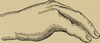 An illustration from Atlas and epitome of traumatic fractures and dislocations / by H. Helferich ; auth. tr. from the German, ed. by Joseph C. Bloodgood. (1902)