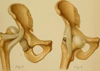 Picture 68 of 91 from Atlas and epitome of traumatic fractures and dislocations / by H. Helferich ; auth. tr. from the German, ed. by Joseph C. Bloodgood. (1902), leaf 363