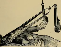 An illustration from Atlas and epitome of traumatic fractures and dislocations / by H. Helferich ; auth. tr. from the German, ed. by Joseph C. Bloodgood. (1902)