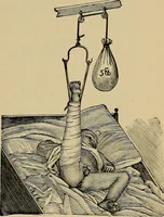 Picture 74 of 91 from Atlas and epitome of traumatic fractures and dislocations / by H. Helferich ; auth. tr. from the German, ed. by Joseph C. Bloodgood. (1902), leaf 405