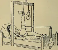 An illustration from Atlas and epitome of traumatic fractures and dislocations / by H. Helferich ; auth. tr. from the German, ed. by Joseph C. Bloodgood. (1902)