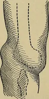 An illustration from Atlas and epitome of traumatic fractures and dislocations / by H. Helferich ; auth. tr. from the German, ed. by Joseph C. Bloodgood. (1902)