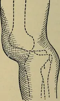 An illustration from Atlas and epitome of traumatic fractures and dislocations / by H. Helferich ; auth. tr. from the German, ed. by Joseph C. Bloodgood. (1902)