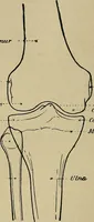 An illustration from Atlas and epitome of traumatic fractures and dislocations / by H. Helferich ; auth. tr. from the German, ed. by Joseph C. Bloodgood. (1902)