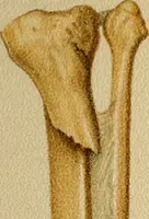An illustration from Atlas and epitome of traumatic fractures and dislocations / by H. Helferich ; auth. tr. from the German, ed. by Joseph C. Bloodgood. (1902)