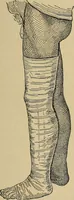 An illustration from Atlas and epitome of traumatic fractures and dislocations / by H. Helferich ; auth. tr. from the German, ed. by Joseph C. Bloodgood. (1902)