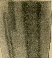 An illustration from Atlas and epitome of traumatic fractures and dislocations / by H. Helferich ; auth. tr. from the German, ed. by Joseph C. Bloodgood. (1902)