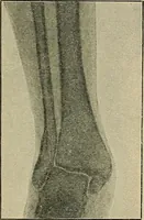 Picture 82 of 91 from Atlas and epitome of traumatic fractures and dislocations / by H. Helferich ; auth. tr. from the German, ed. by Joseph C. Bloodgood. (1902), leaf 476