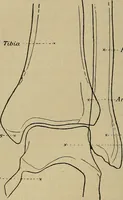 An illustration from Atlas and epitome of traumatic fractures and dislocations / by H. Helferich ; auth. tr. from the German, ed. by Joseph C. Bloodgood. (1902)