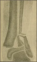 An illustration from Atlas and epitome of traumatic fractures and dislocations / by H. Helferich ; auth. tr. from the German, ed. by Joseph C. Bloodgood. (1902)