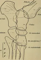 An illustration from Atlas and epitome of traumatic fractures and dislocations / by H. Helferich ; auth. tr. from the German, ed. by Joseph C. Bloodgood. (1902)