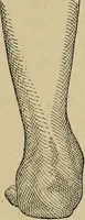 An illustration from Atlas and epitome of traumatic fractures and dislocations / by H. Helferich ; auth. tr. from the German, ed. by Joseph C. Bloodgood. (1902)