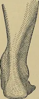 An illustration from Atlas and epitome of traumatic fractures and dislocations / by H. Helferich ; auth. tr. from the German, ed. by Joseph C. Bloodgood. (1902)