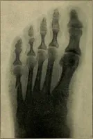 Picture 90 of 91 from Atlas and epitome of traumatic fractures and dislocations / by H. Helferich ; auth. tr. from the German, ed. by Joseph C. Bloodgood. (1902), leaf 496