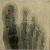 An illustration from Atlas and epitome of traumatic fractures and dislocations / by H. Helferich ; auth. tr. from the German, ed. by Joseph C. Bloodgood. (1902)