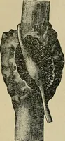 An illustration from Atlas and epitome of traumatic fractures and dislocations / by H. Helferich ; auth. tr. from the German, ed. by Joseph C. Bloodgood. (1902)