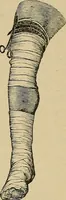 An illustration from Atlas and epitome of traumatic fractures and dislocations / by H. Helferich ; auth. tr. from the German, ed. by Joseph C. Bloodgood. (1902)